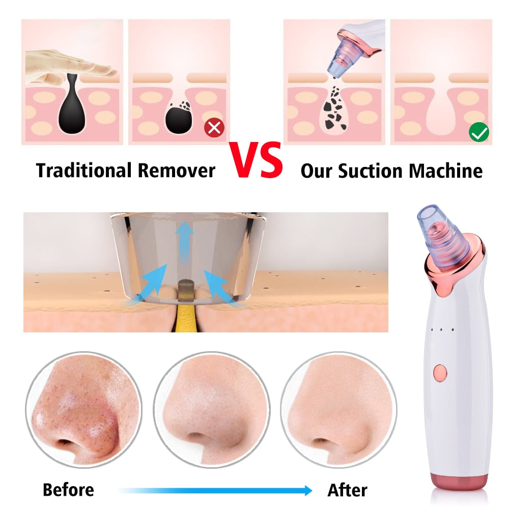 Blackhead Instrument Electric Suction Facial Washing Instrument Beauty Acne Cleaning Blackhead Suction Instrument - QWIEL®
