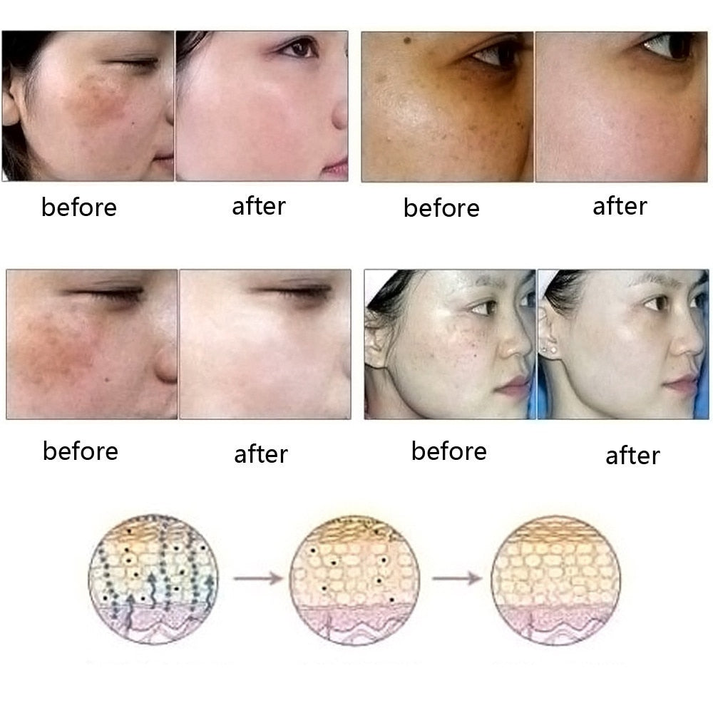 Dredge Meridian Skin Care Natural Pure Removal Acne Stretch Marks Scar Removal Essence oil - QWIEL®