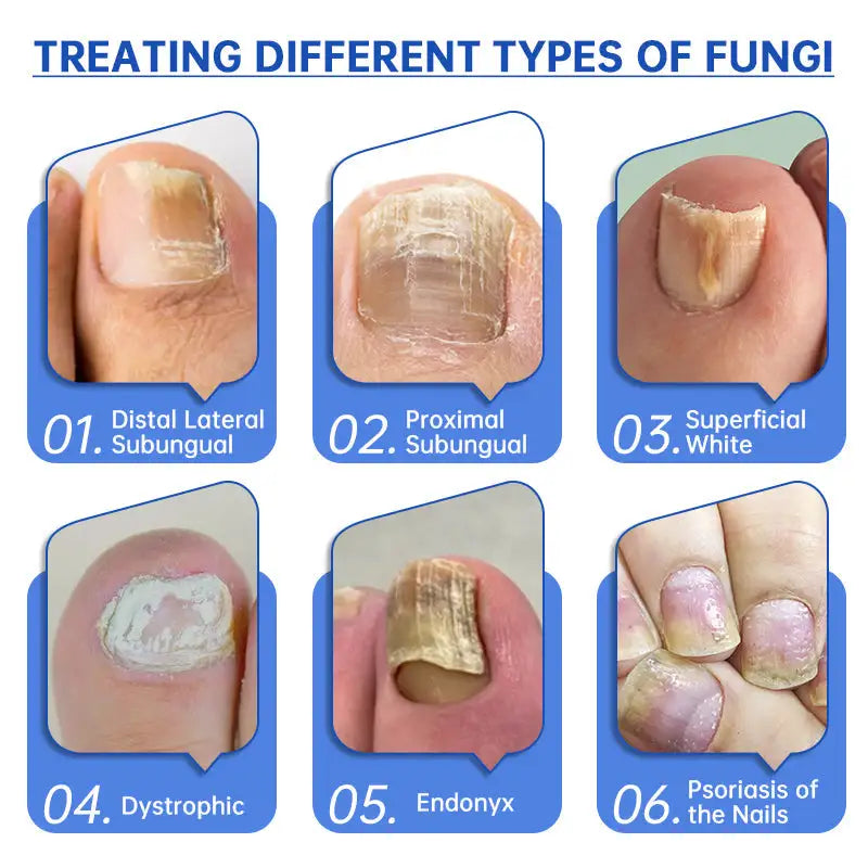 Fungus Laser Therapy Device